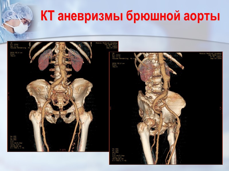 КТ аневризмы брюшной аорты